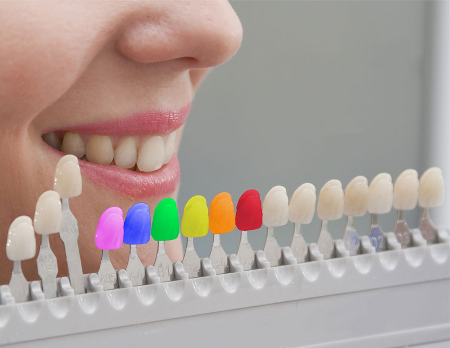 LG 1بهترین رنگ کامپوزیت در دندانپزشکی
