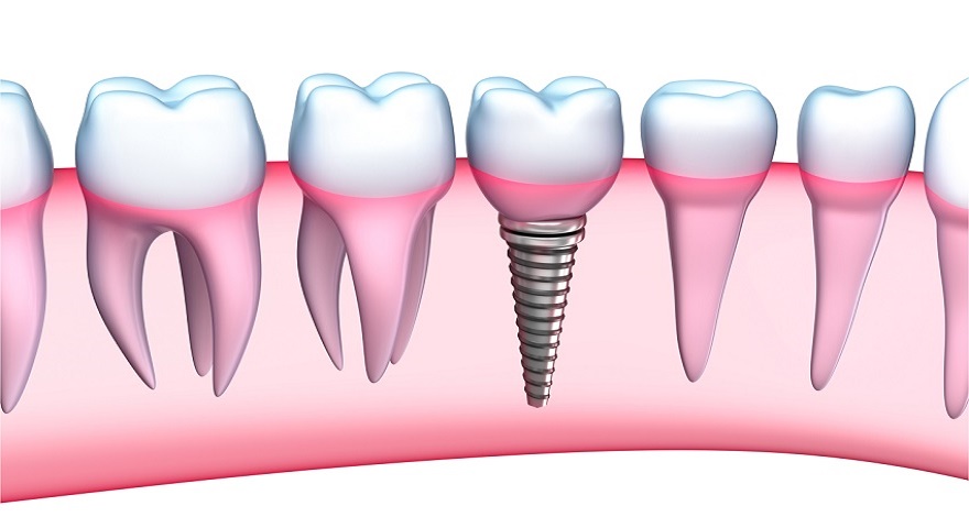 LG bigstock Dental Implant detailed view 39564646small