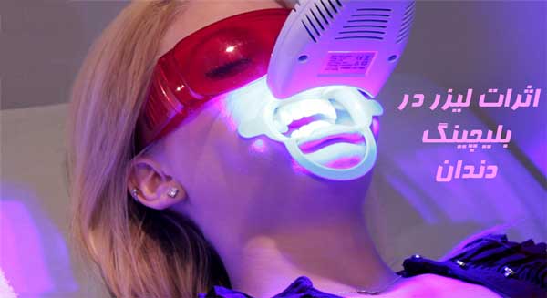 LG اثرات لیزر در بلیچینگ دندان