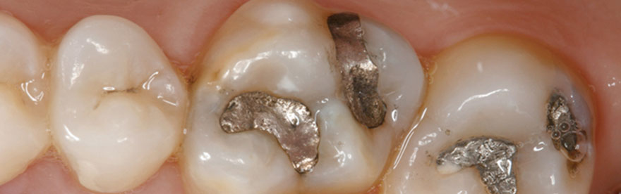 LG مواد ترمیمی در دندانپزشکی